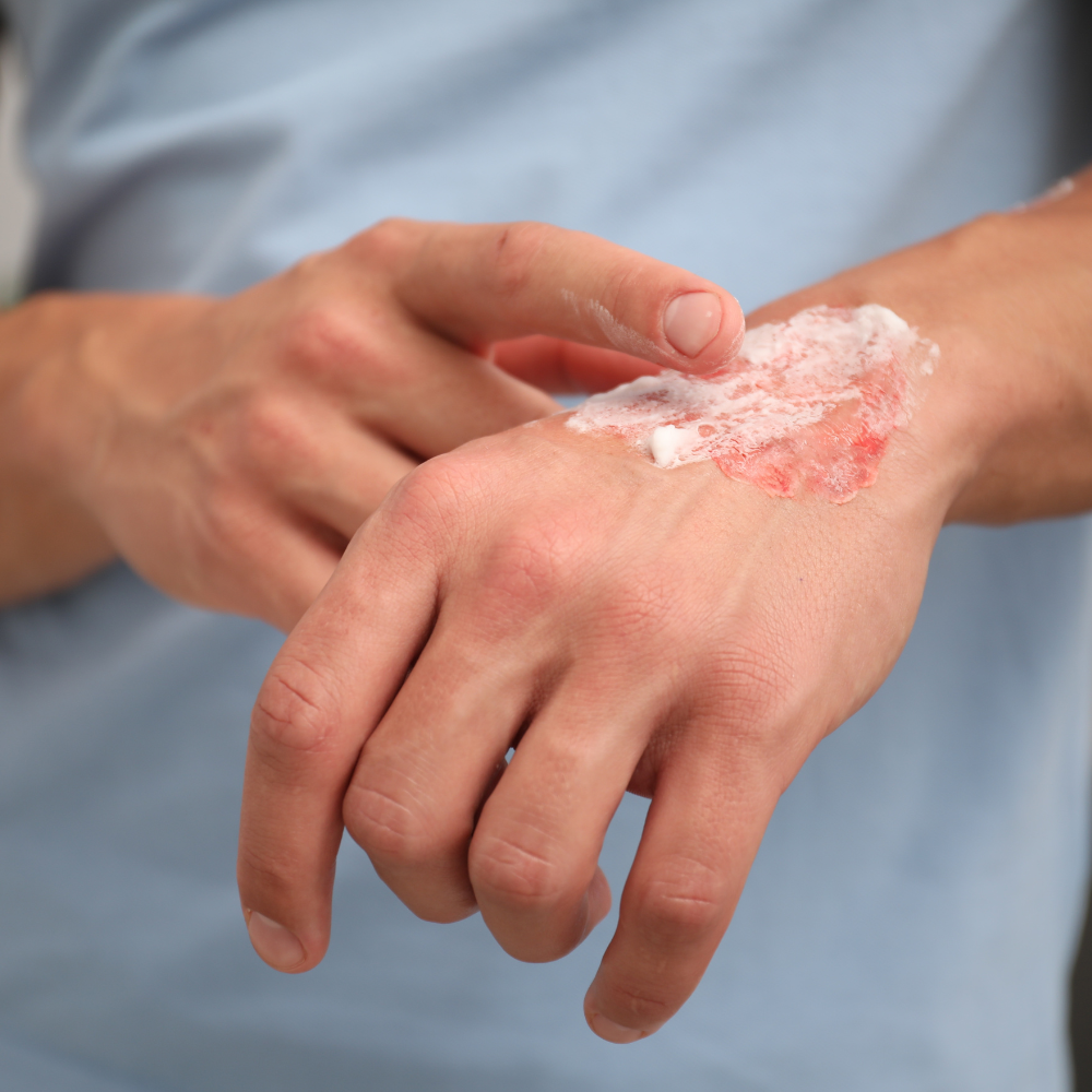 Topical Pain Creams