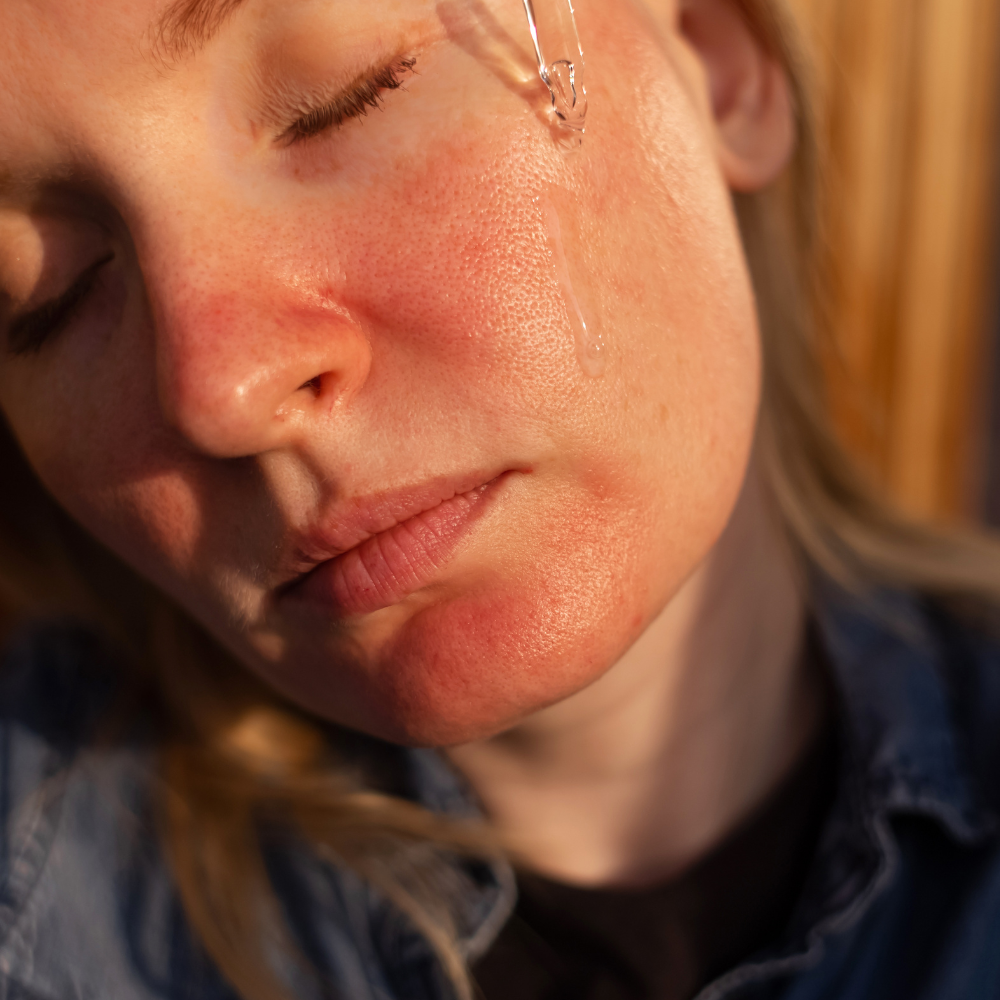 Rosacea/sensitive skin