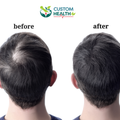 Hair restoration