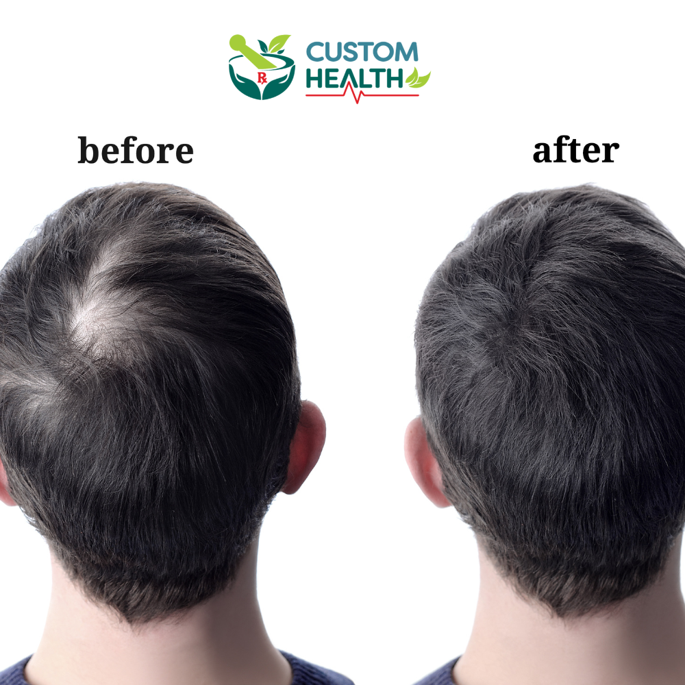 Hair restoration